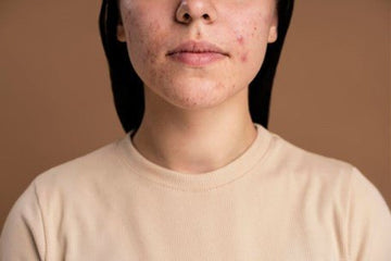 Acne Skin