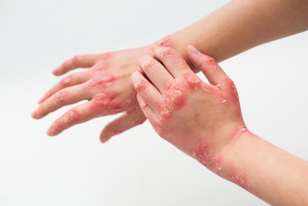 How can Traditional Chinese Medicine (TCM) help with eczema?